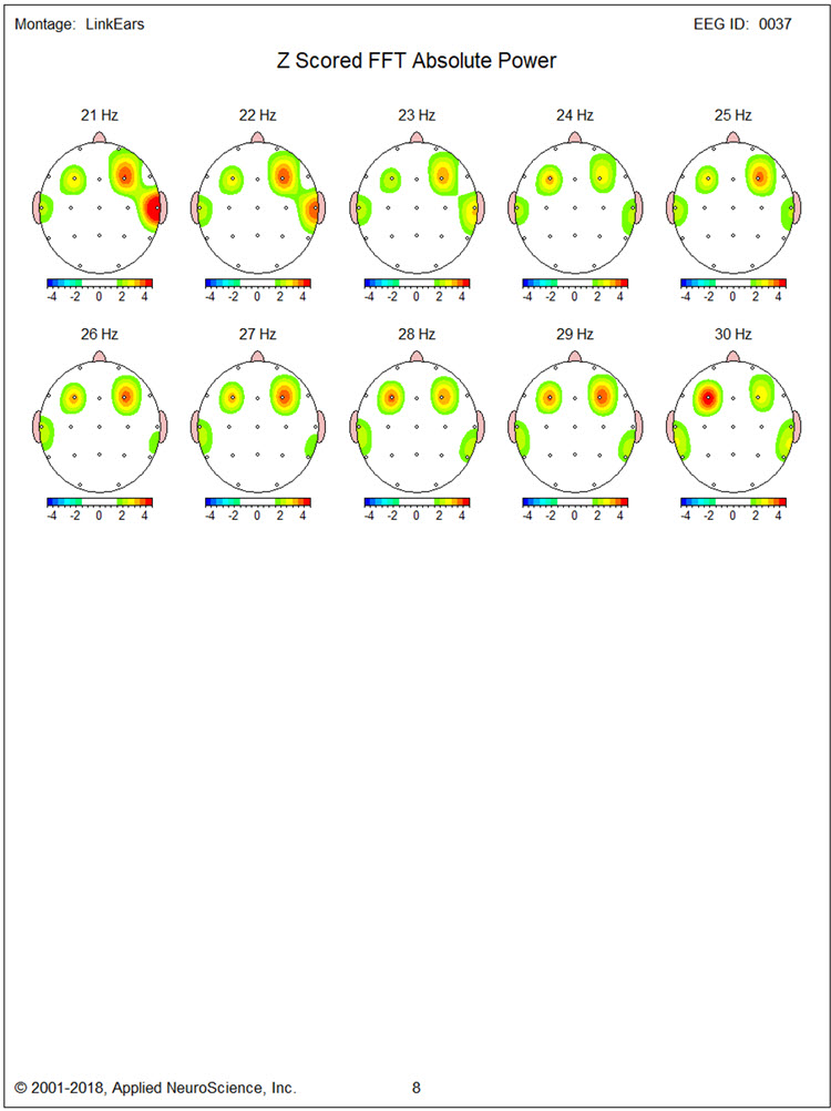 Figure 11 - Baseline eyes-open z-score FFT absolute power single-Hz bins 21-30 Hz